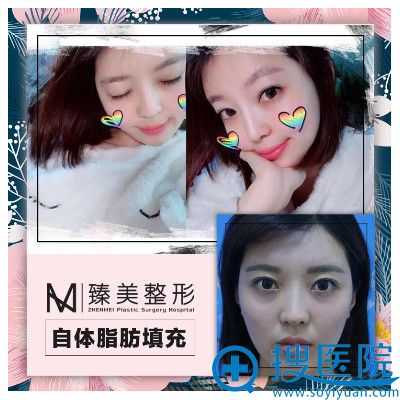 哈尔滨臻美整形医院<!--<i data=20240710 data-id=16623></i>-->自体脂肪填充案例 哈尔滨臻美整形医院<!--<i data=20240710 data-id=16623></i>-->自体脂肪填充案例