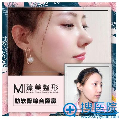 哈尔滨臻美整形医院王丹丹隆鼻好不好?隆鼻失败修复案例 哈尔滨臻美整形医院王丹丹隆鼻好不好?隆鼻失败修复案例