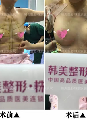 二胎宝妈产后胸部干瘪下垂毅然选择株洲韩美做假体丰胸的经历