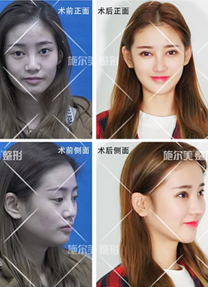 员工在常州施尔美做过自体肋软骨鼻综合隆鼻术后10天全记录