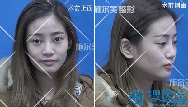 常州施尔美员工做隆鼻前 常州施尔美员工做隆鼻前