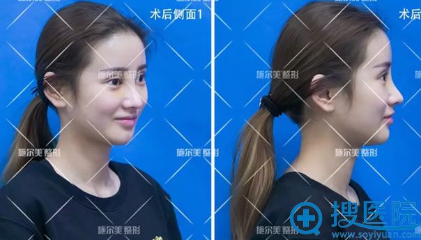 施尔美员工做过隆鼻后7天恢复照 施尔美员工做过隆鼻后7天恢复照