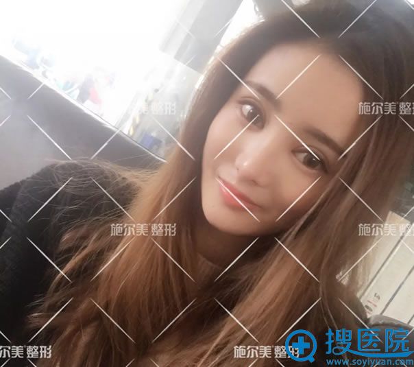 常州施尔美自体肋软骨隆鼻10天效果 常州施尔美自体肋软骨隆鼻10天效果