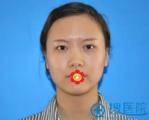 兰州亚韩员工做双眼皮前的内双 兰州亚韩员工做双眼皮前的内双