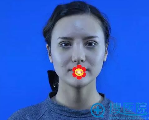 兰州亚韩员工做双眼皮7天恢复效果 兰州亚韩员工做双眼皮7天恢复效果