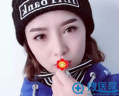 兰州亚韩谢雯开眼角案例图 兰州亚韩谢雯开眼角案例图