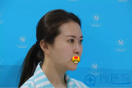 不满意玻尿酸隆鼻效果 她找青岛华颜美李爱群做了鼻综合手术