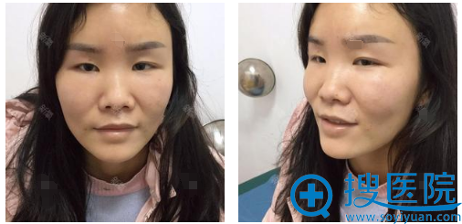姐姐鼻子超美是因为她找苏州芘丽芙华美黄旭医生做了鼻综合隆鼻
