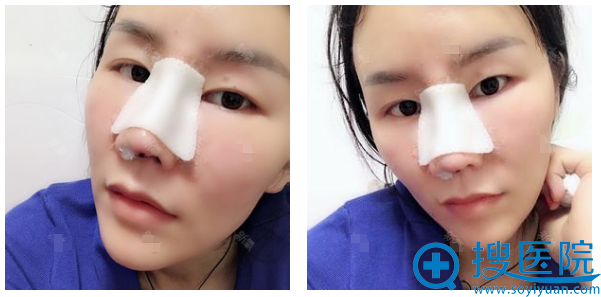 苏州芘丽芙华美黄旭医生隆鼻案例10天效果图 苏州芘丽芙华美黄旭医生隆鼻案例10天效果图