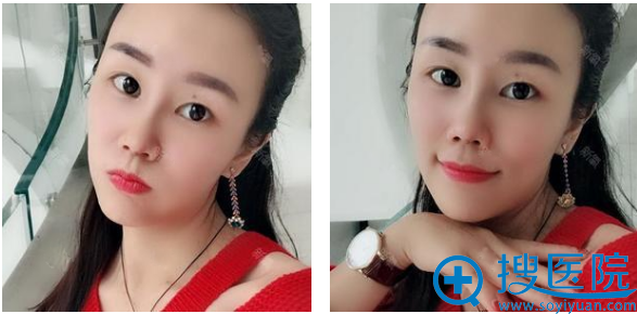 苏州芘丽芙华美黄旭隆鼻怎么样?鼻综合案例一个月效果图 苏州芘丽芙华美黄旭隆鼻怎么样?鼻综合案例一个月效果图