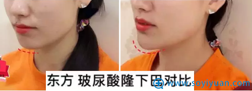 郑州东方玻尿酸丰下巴效果展示 郑州东方玻尿酸丰下巴效果展示