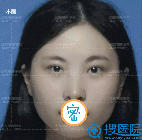 郑州东方玻尿酸隆下巴术前正面照 郑州东方玻尿酸隆下巴术前正面照