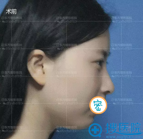 玻尿酸丰下巴术前侧面照 玻尿酸丰下巴术前侧面照