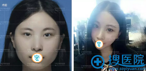 郑州东方玻尿酸隆下巴术前术后对比 郑州东方玻尿酸隆下巴术前术后对比