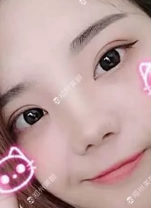 去年回国找郑州美眼田国静医生做开眼角和双眼皮 现10个月了