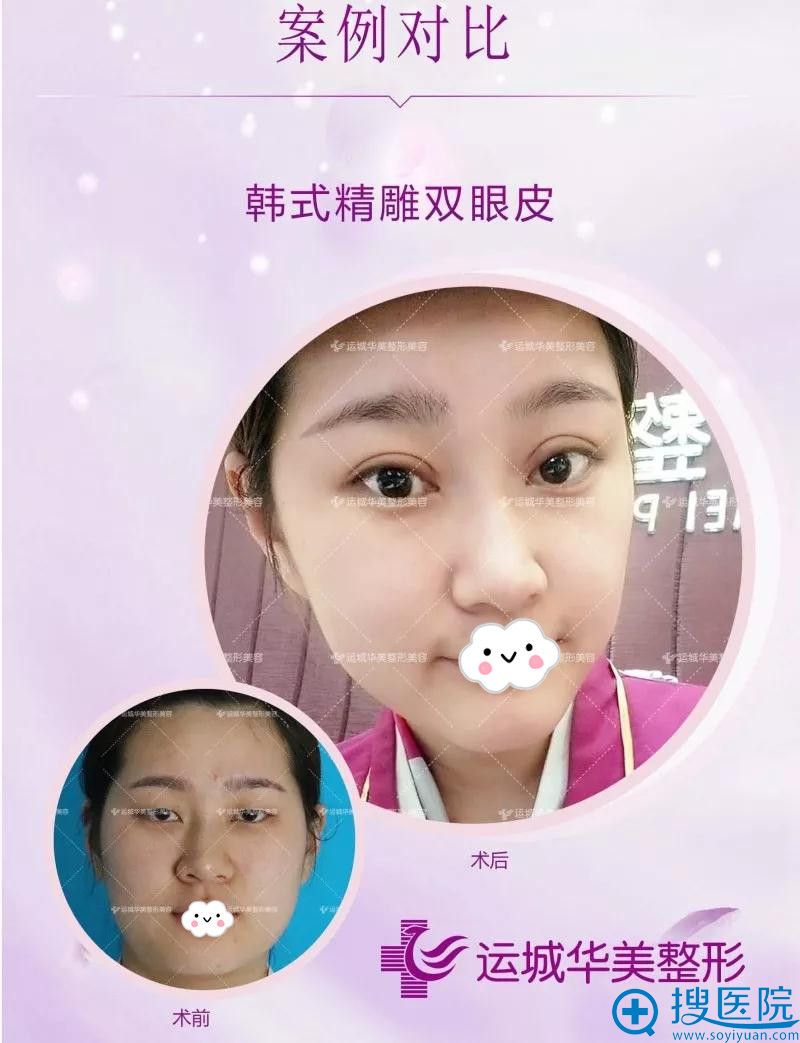 运城华美双眼皮案例 运城华美双眼皮案例