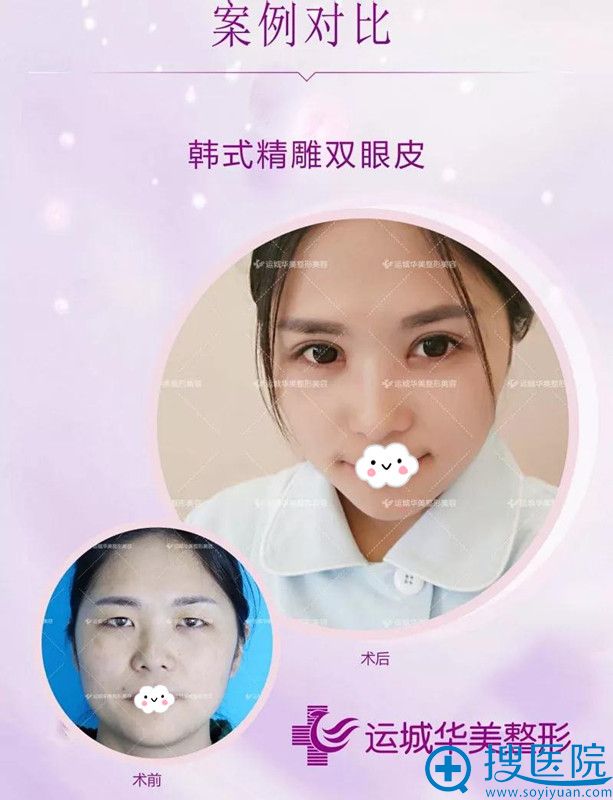 运城华美精雕双眼皮效果对比 运城华美精雕双眼皮效果对比