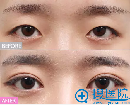 双眼皮有效改善眼裂狭窄案例 双眼皮有效改善眼裂狭窄案例
