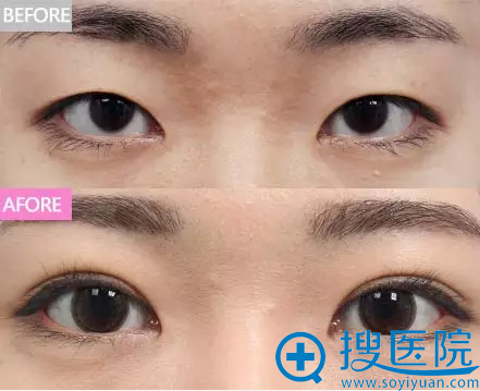 双眼皮有效改善轻度倒睫效果 双眼皮有效改善轻度倒睫效果