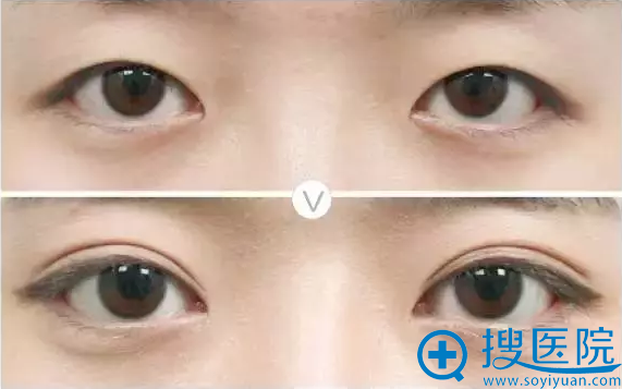 上睑下垂通过双眼皮手术呈现美眼效果 上睑下垂通过双眼皮手术呈现美眼效果