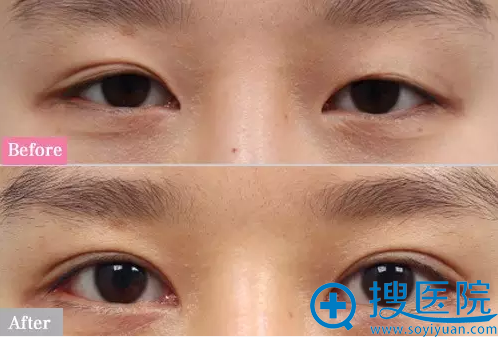 双眼皮手术有效改善了眼睛不对称问题 双眼皮手术有效改善了眼睛不对称问题