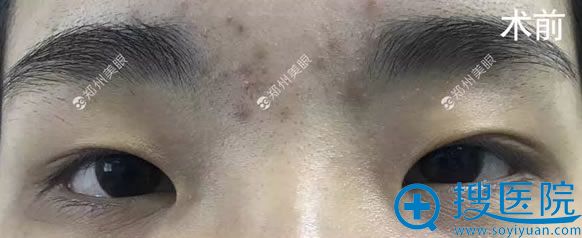 做开内眼角和双眼皮手术前 做开内眼角和双眼皮手术前