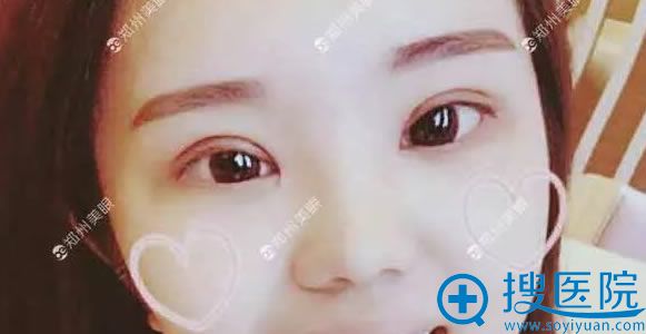 在<!--<i data=20240710 data-id=12686></i>-->做开眼角和双眼皮1个月啦 在<!--<i data=20240710 data-id=12686></i>-->做开眼角和双眼皮1个月啦