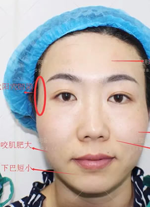 淄博向东整形医院高勇院长为咨询师做面部脂肪填充30天后效果