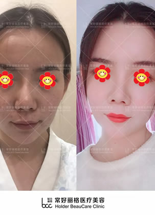 26岁在校研究生选择北京常好丽格医疗美容做自体脂肪填充全脸