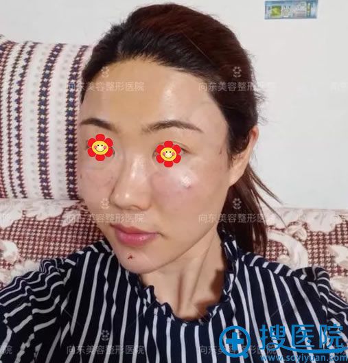��������֬�����ȫ��1���Ч��