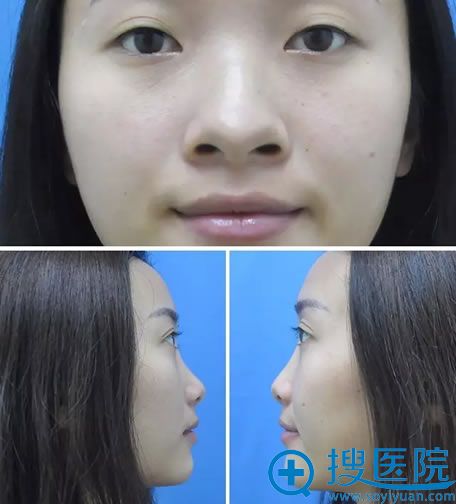 术前的塌鼻子和大鼻头 术前的塌鼻子和大鼻头