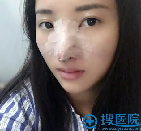 <!--<i data=20240710 data-id=11573></i>-->整形鼻综合术后2天 <!--<i data=20240710 data-id=11573></i>-->整形鼻综合术后2天