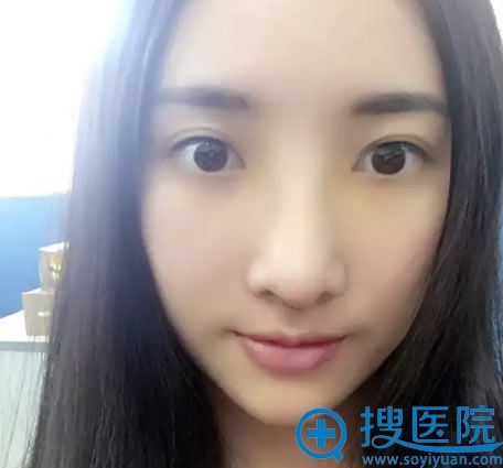 做完鼻综合手术7天拆线效果 做完鼻综合手术7天拆线效果