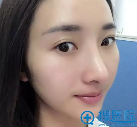 在<!--<i data=20240710 data-id=11573></i>-->做鼻综合15天效果 在<!--<i data=20240710 data-id=11573></i>-->做鼻综合15天效果