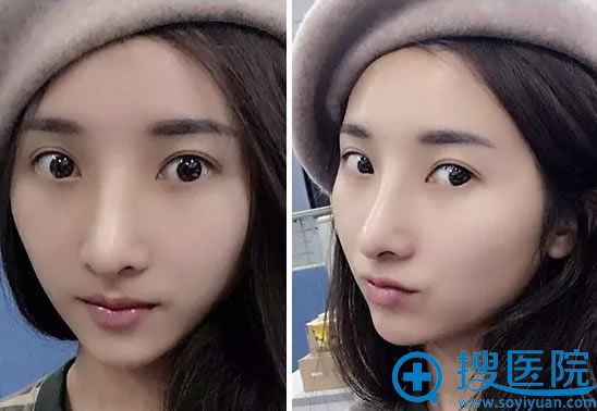 <!--<i data=20240710 data-id=11573></i>-->整形王晓辰鼻综合案例 <!--<i data=20240710 data-id=11573></i>-->整形王晓辰鼻综合案例