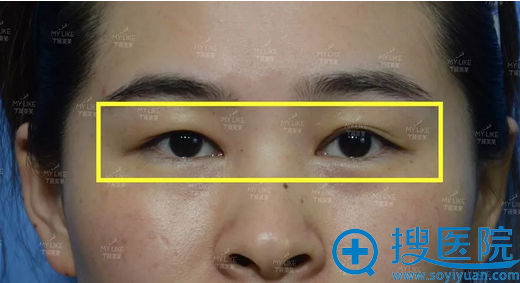 宁波美莱喻正虹双眼皮+面部脂肪填充手术让她摆脱大小眼大妈脸