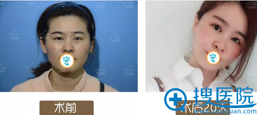 喻正虹双眼皮+面部脂肪填充术后对比 喻正虹双眼皮+面部脂肪填充术后对比