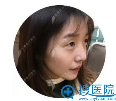 做鼻综合之前鼻子不挺的照片 做鼻综合之前鼻子不挺的照片