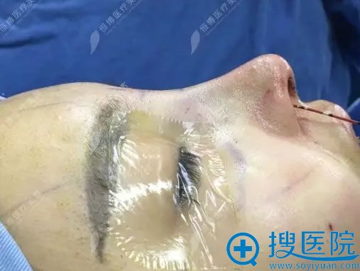 做完耳软骨垫鼻尖和假体隆鼻即刻效果 做完耳软骨垫鼻尖和假体隆鼻即刻效果