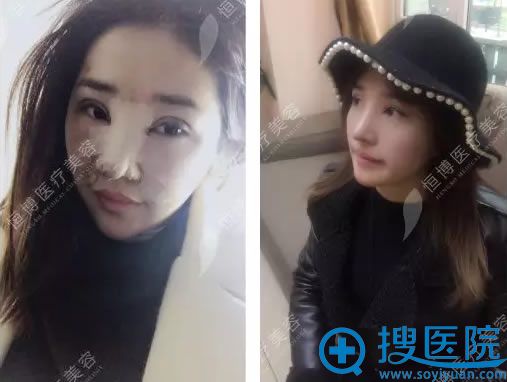 成都恒博做鼻综合手术恢复期 成都恒博做鼻综合手术恢复期