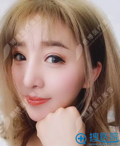 在恒博做完鼻子后1个月效果 在恒博做完鼻子后1个月效果