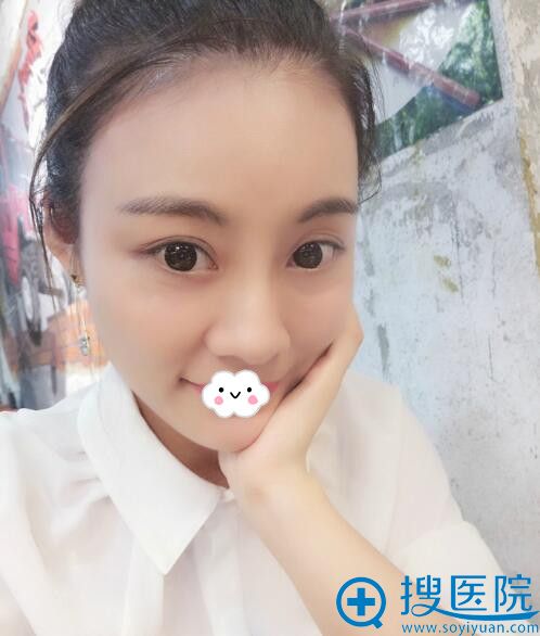 重庆联合丽格自体脂肪面部填充效果 重庆联合丽格自体脂肪面部填充效果