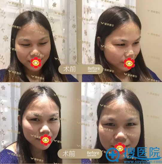 慧慧做隆鼻和双眼皮综合手术前 慧慧做隆鼻和双眼皮综合手术前