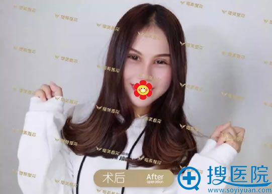 <!--<i data=20240710 data-id=10957></i>-->杨孟根眼鼻综合案例15天效果 <!--<i data=20240710 data-id=10957></i>-->杨孟根眼鼻综合案例15天效果