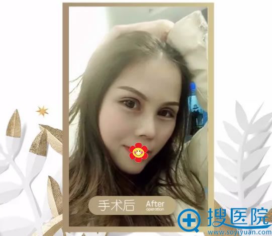 南宁杨孟根眼鼻综合整形案例 南宁杨孟根眼鼻综合整形案例