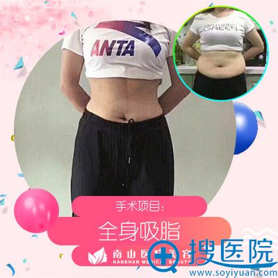 <!--<i data=20240710 data-id=2340></i>-->医生刘记做的全身吸脂整形案例 <!--<i data=20240710 data-id=2340></i>-->医生刘记做的全身吸脂整形案例