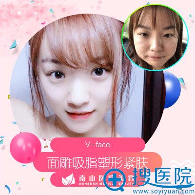 上海南山整形美容卢立新医生面部吸脂案例 上海南山整形美容卢立新医生面部吸脂案例