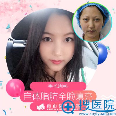 <!--<i data=20240710 data-id=2340></i>-->医生刘记自体脂肪全脸填充整形案例 <!--<i data=20240710 data-id=2340></i>-->医生刘记自体脂肪全脸填充整形案例