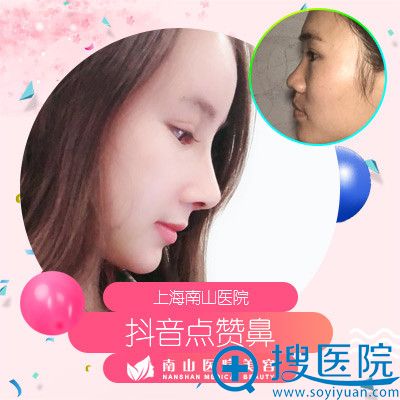 <!--<i data=20240710 data-id=2340></i>-->医生刘记做的鼻综合隆鼻整形案例 <!--<i data=20240710 data-id=2340></i>-->医生刘记做的鼻综合隆鼻整形案例