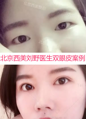 看了北京西美刘野和吕薇医生双眼皮案例效果 选择刘主任做眼睛